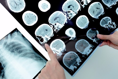 Exposure to Asbestos