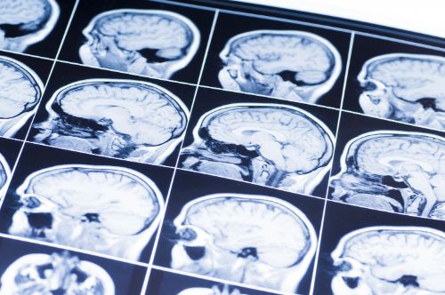 Choosing an Attorney for a Brain Injury Claim in Buffalo NY